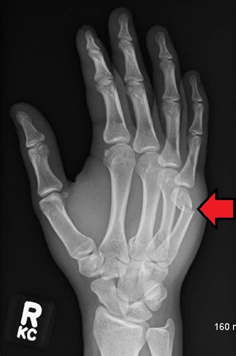 displaced boxers fracture